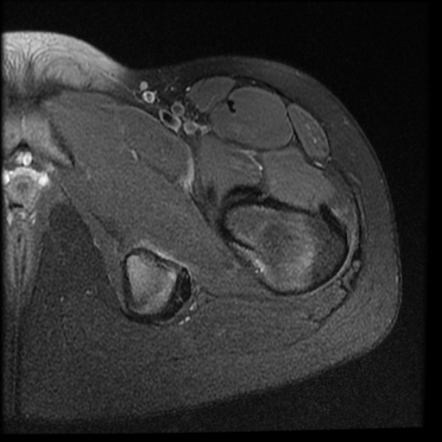 Ischial apophyseal stress injury | Image | Radiopaedia.org