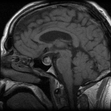 Pituitary Adenoma | Radiology Reference Article | Radiopaedia.org