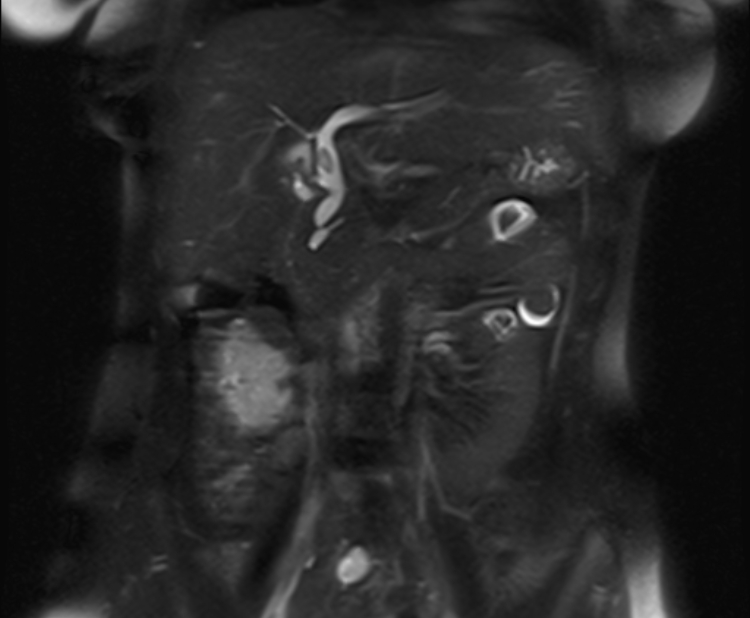 Choledochal cyst - type Ic (MRCP) | Image | Radiopaedia.org