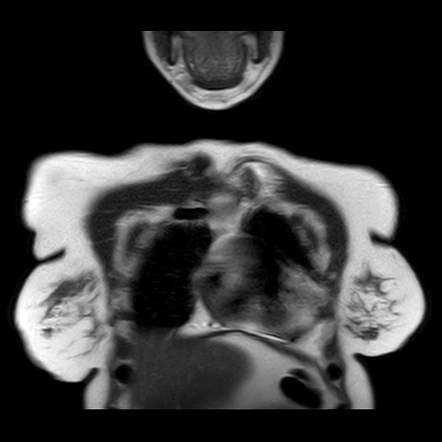 Tietze Syndrome Image Radiopaedia Org