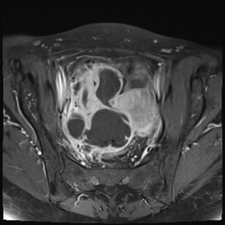 Tubo-ovarian Abscess | Radiology Reference Article | Radiopaedia.org