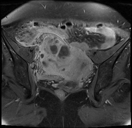 Tubo-ovarian Abscess | Image | Radiopaedia.org