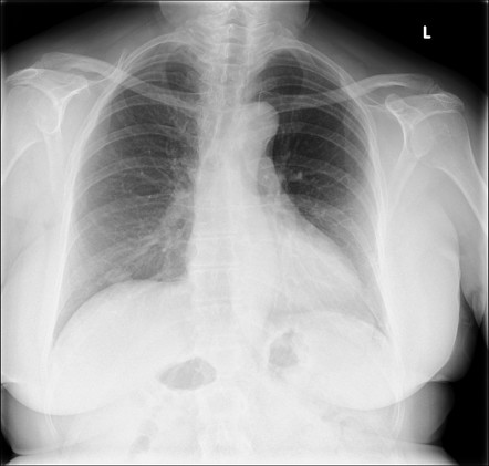 Pulmonary Hamartoma 