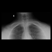 Chest (ap Lordotic View) 