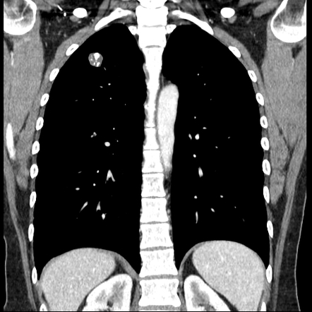 Pulmonary hamartoma | Radiology Reference Article | Radiopaedia.org