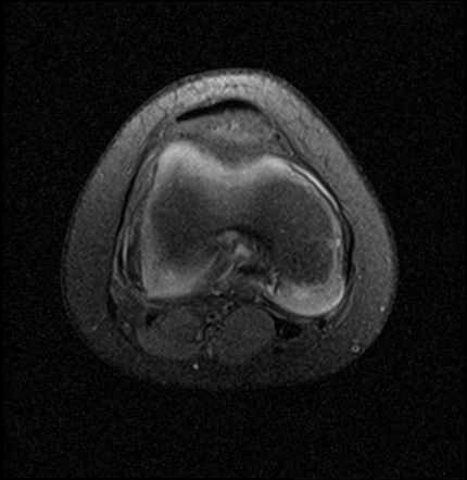 Discoid lateral meniscus with parameniscal cyst | Image | Radiopaedia.org