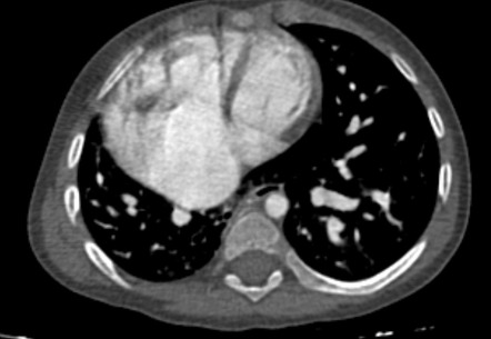 Scimitar syndrome with associated horseshoe lung | Image | Radiopaedia.org