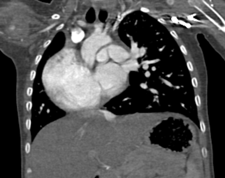 Scimitar syndrome with associated horseshoe lung | Image | Radiopaedia.org