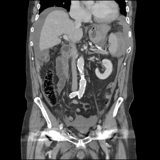 Splenic laceration | Image | Radiopaedia.org