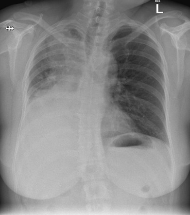 Malignant tracheal compression treated with tracheobronchial stent ...