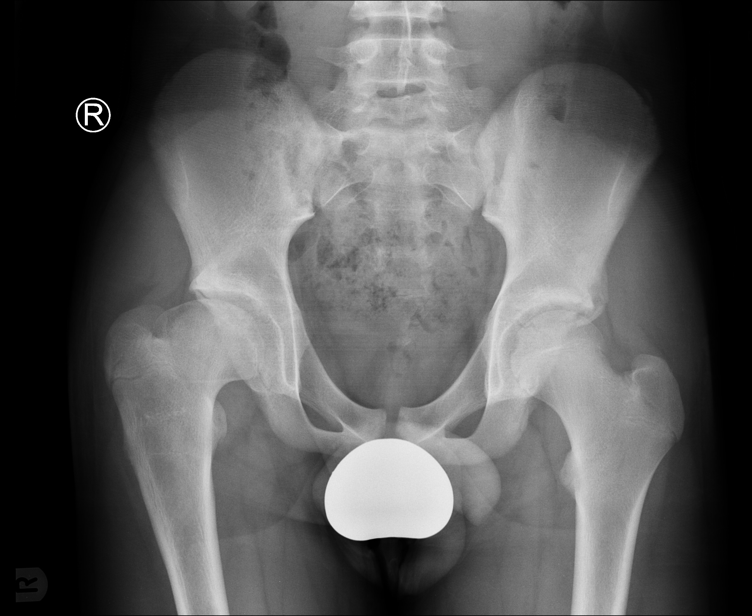 Rectus Femoris Avulsion Injury Image