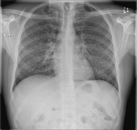 Miliary tuberculosis | Radiology Reference Article | Radiopaedia.org