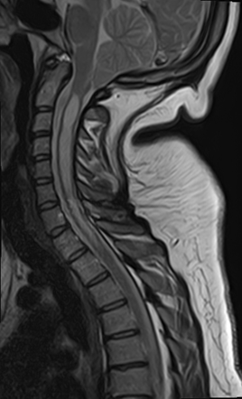 Chiari I malformation with syrinx | Radiology Case | Radiopaedia.org