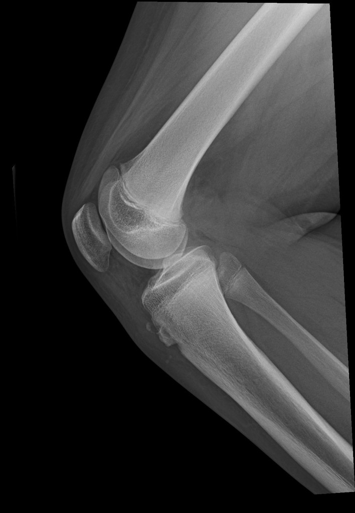 Osgood Schlatter Disease X Ray