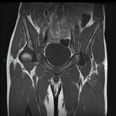 Rectus femoris avulsion injury | Image | Radiopaedia.org