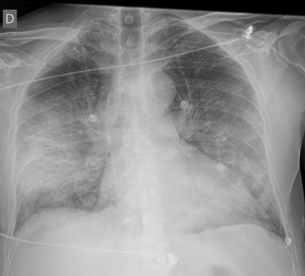 COVID-19 | Radiology Reference Article | Radiopaedia.org