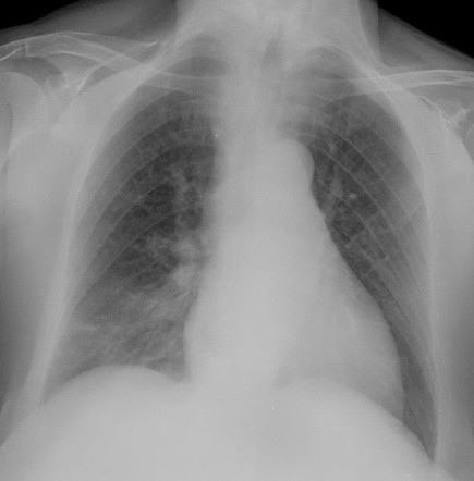 COVID-19 pneumonia | Radiology Case | Radiopaedia.org