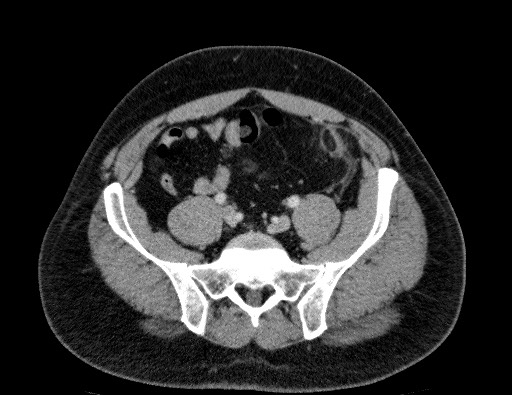 Epiploic appendagitis | Image | Radiopaedia.org