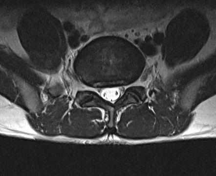 Annular Fissure Image Radiopaedia Org