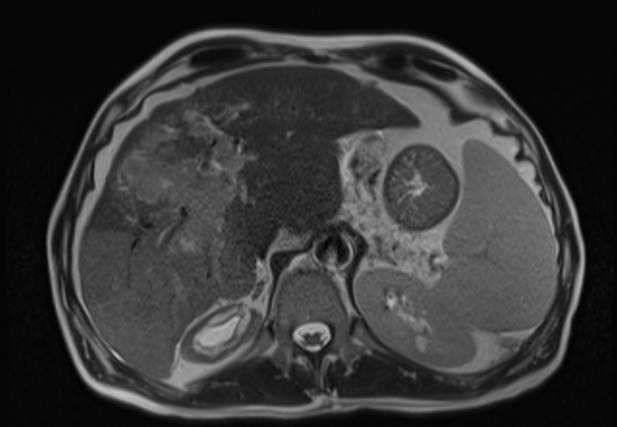 Infiltrative HCC - portal vein tumor thrombus | Image | Radiopaedia.org