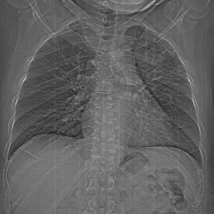 Brain metastases - lung cancer primary | Image | Radiopaedia.org