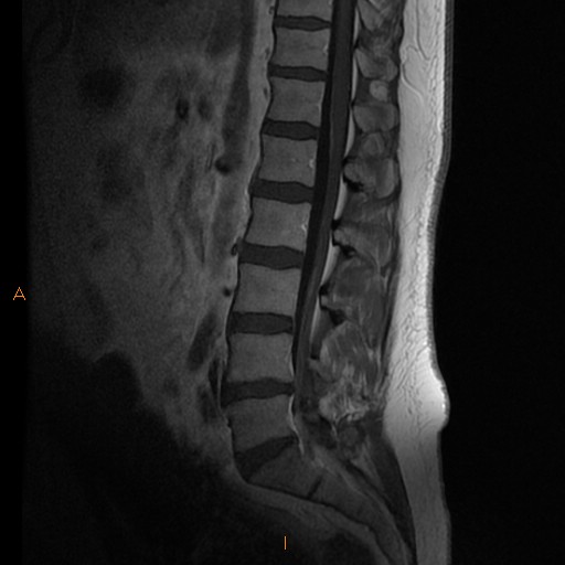 Chronic Inflammatory Demyelinating Polyneuropathy (CIDP) | Image ...