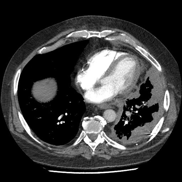 Mesothelioma | Radiology Reference Article | Radiopaedia.org