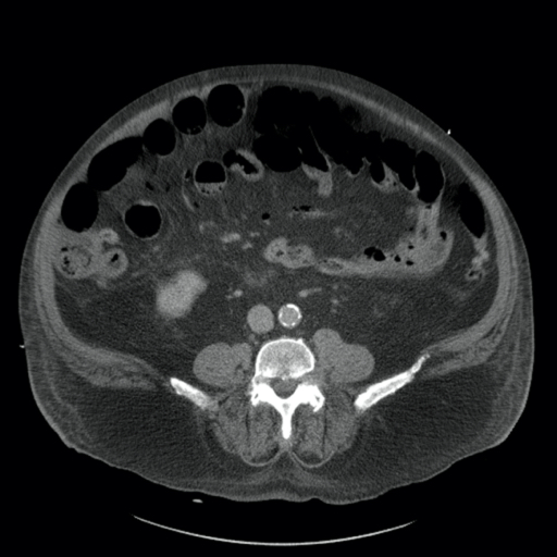 Bowel ischemia with portal venous gas | Image | Radiopaedia.org