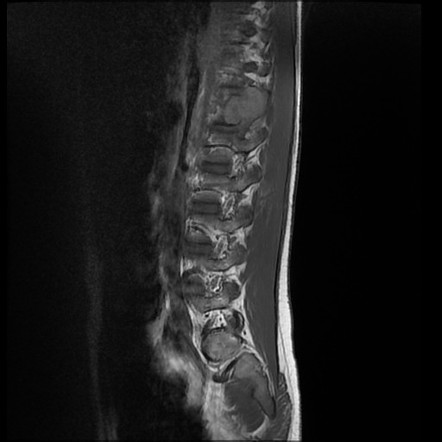 Aneurysmal Bone Cyst Spine Image Radiopaedia Org