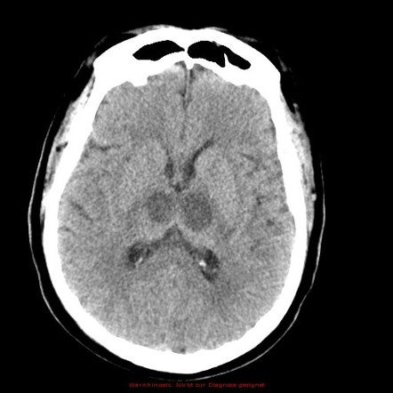 Artery of Percheron territory infarct | Radiology Reference Article ...