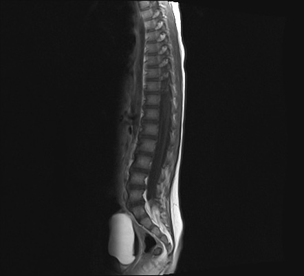 Atypical Teratoid Rhabdoid Tumor (AT/RT) | Image | Radiopaedia.org