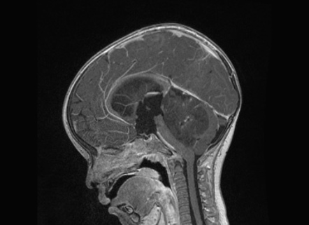 Atypical Teratoid Rhabdoid Tumor (AT/RT) | Image | Radiopaedia.org