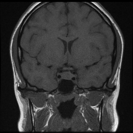 Pituitary Prolactinoma - Medically Treated | Image | Radiopaedia.org