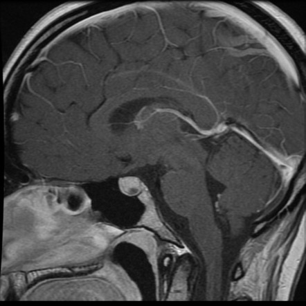 Pituitary Prolactinoma - Medically Treated | Image | Radiopaedia.org