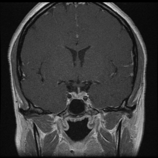 Pituitary prolactinoma - medically treated | Image | Radiopaedia.org