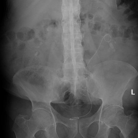 Bamboo spine (ankylosing spondylitis) | Radiology Reference Article ...