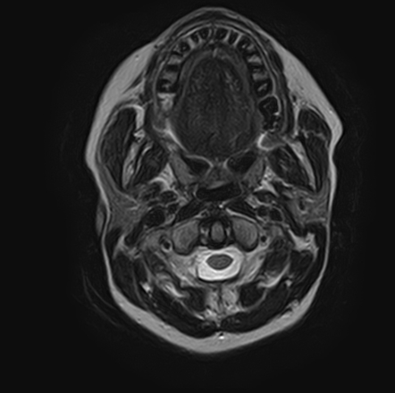 Adenoid cystic carcinoma - maxillary sinus | Image | Radiopaedia.org