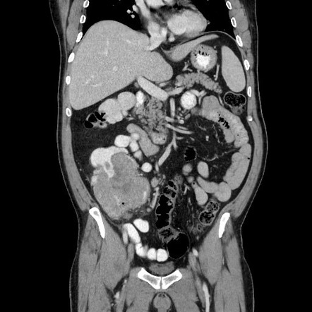 Massive caecal adenocarcinoma | Radiology Case | Radiopaedia.org