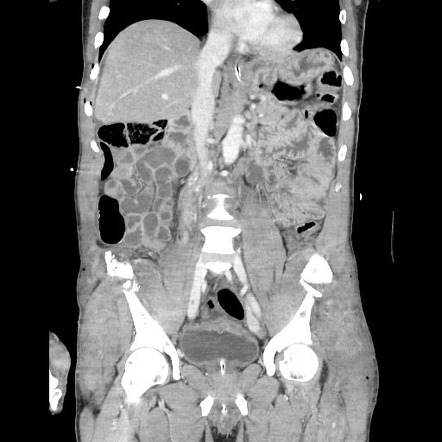 Polytrauma with intraperitoneal bladder rupture | Image | Radiopaedia.org