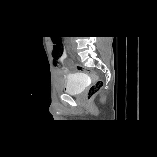 Polytrauma with intraperitoneal bladder rupture | Image | Radiopaedia.org