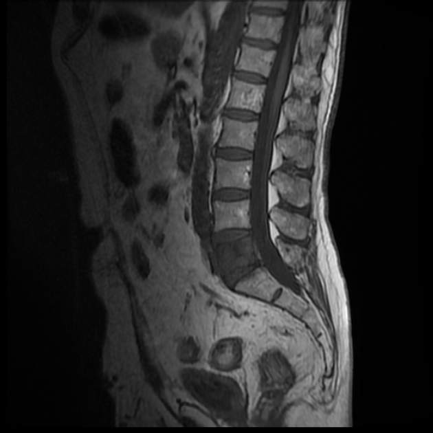 Vertebral metastases | Radiology Reference Article | Radiopaedia.org