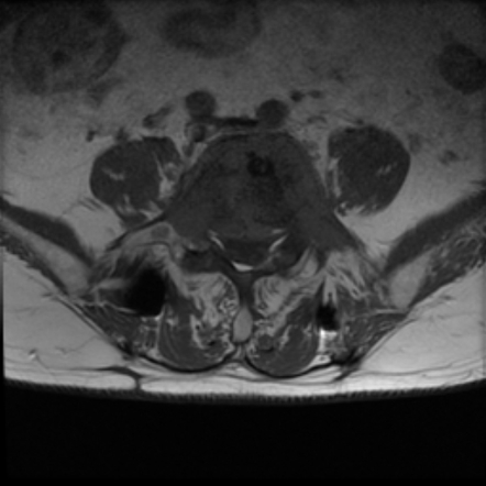 Vertebral metastases from prostate cancer | Image | Radiopaedia.org