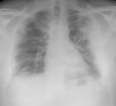 COVID-19 pneumonia | Radiology Case | Radiopaedia.org