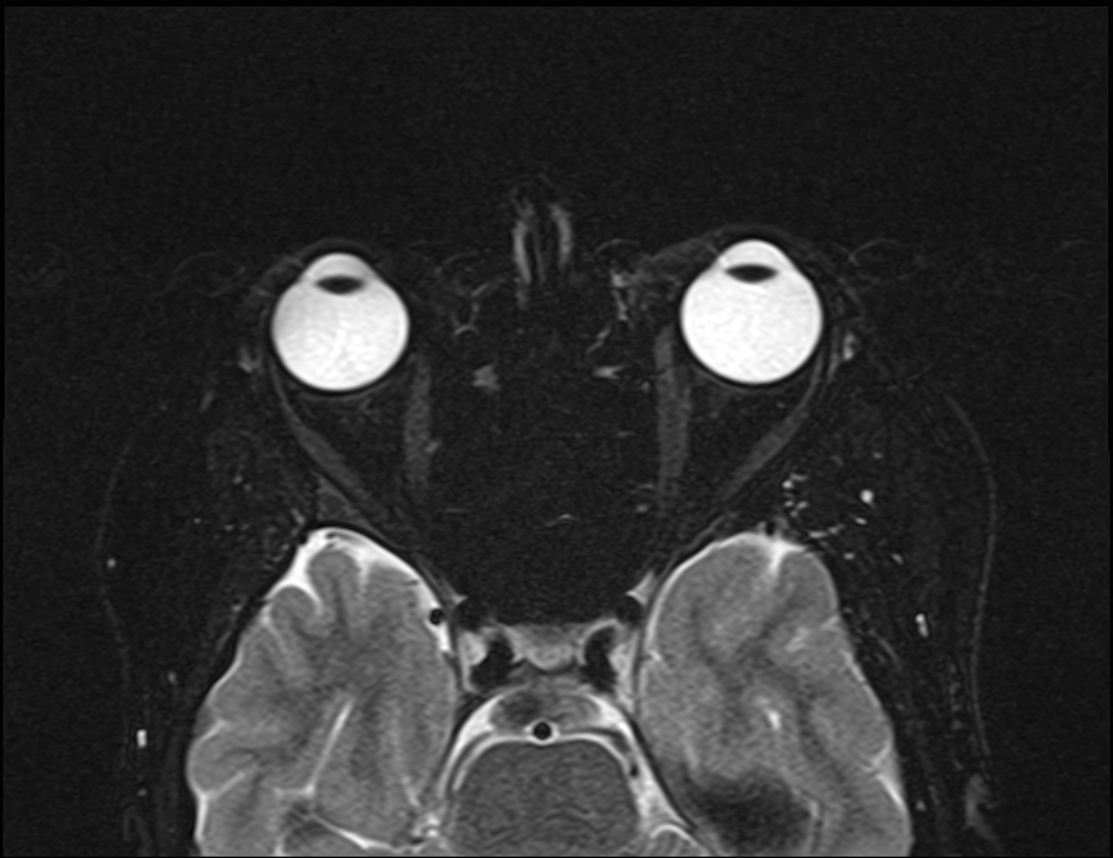 Sturge-Weber syndrome | Image | Radiopaedia.org