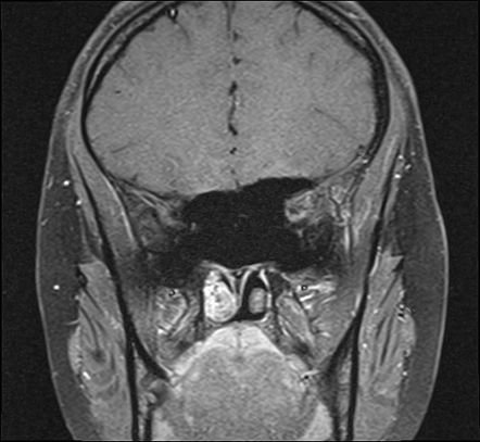 Sturge-Weber syndrome | Image | Radiopaedia.org