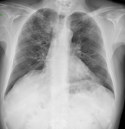 COVID-19 | Radiology Reference Article | Radiopaedia.org