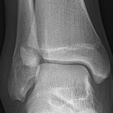 Tillaux fracture | Radiology Reference Article | Radiopaedia.org