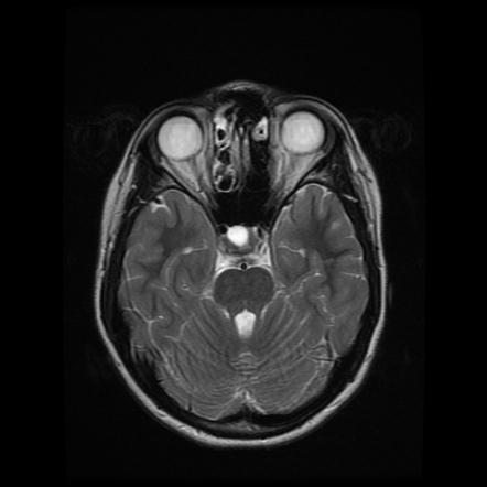 Rathke cleft cyst | Image | Radiopaedia.org