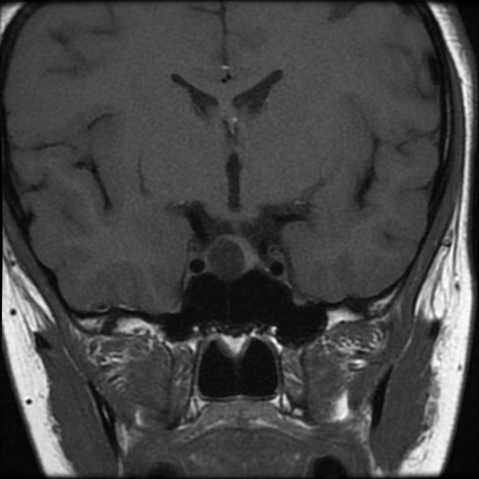 Rathke cleft cyst | Image | Radiopaedia.org