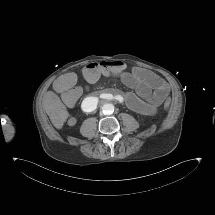 Incarcerated femoral hernia with small bowel obstruction